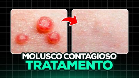 como eliminar molusco contagioso naturalmente|Combate los molestos Moluscos Contagiosos con。